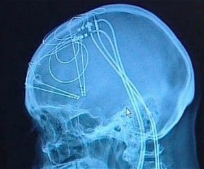 First Deep Brain Stimulation What is Deep Brain Stimulation? - Robert JR Graham